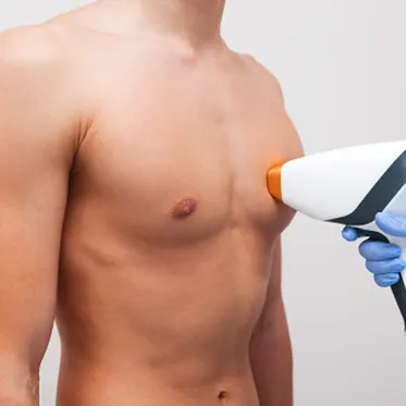 Epilation definitive au laser du torse chez l-homme